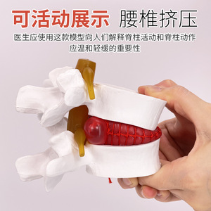 Modelo de columna lumbar, para la demostración médica de la compresión del disco intervertebral lumbar y la patología de osteófitos espinales. - Product Image 4