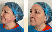 Chirurgie de liposuccion professionnelle, laser diode 980 nm, lipolyse, machine de remodelage corporel, lifting endolaser