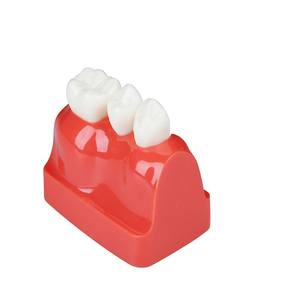 4 volte la scienza medica impianto dentale modello porcellana denti amovibile corona ponte impiallacciature per l'insegnamento di materiale plastico - Product Image 2