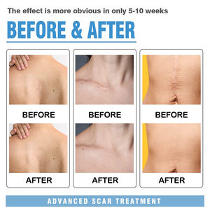 Carbou Ultra Dunne En Ademende Herbruikbare Wasbare Littekens Verwijderen Comfortabele Pijnloze Zachte Littekenplaat Siliconen Tape Wond Gips - Product Image 3