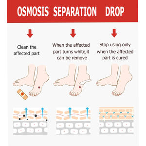 Lijitang toppa di rimozione del mais medico senza dolore per la cura dei <span class=keywords><strong>piedi</strong></span> ammorbidire la pelle Cutin adesivo callo in gesso rimuovere la fornitura di assistenza sanitaria - Product Image 4