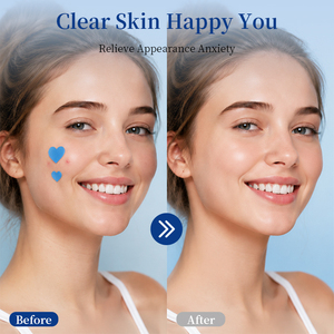 Parche de Hidrocoloide Azul Personalizado para el Acné, Absorbe el Exceso de Sebo y Pus, Aísla la Suciedad para Proteger la Piel con Imperfecciones Durante Todo el Día - Product Image 6