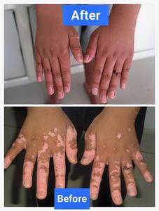 Bon système Phototherpay Laser Excimer efficace Cn-308p6 du noyau 308 Excimer R Traitement ciblé du psoriasis Vitiligo - Product Image 4