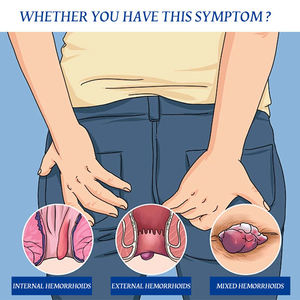 Nam trăng Trung Quốc Kem thảo dược thuốc mỡ cho bệnh trĩ bên ngoài giảm đau thành phần tự nhiên chăm sóc cá nhân chăm sóc sức khỏe - Product Image 2