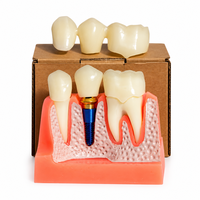 Modèle d'implant dentaire pédagogique, modèle détachable de couronne dentaire et de visqueuse pour la formation des dentistes et l'affichage en clinique