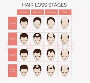 Nuevo Modelo de Diodos Láser de 424 Piezas y 5mW, Equipo de Alta Calidad para el Crecimiento del Cabello, para la <span class=keywords><strong>Alopecia</strong></span> Androgenética y la <span class=keywords><strong>Alopecia</strong></span> <span class=keywords><strong>Areata</strong></span> - Product Image 5