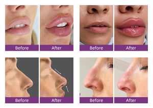 <span class=keywords><strong>Meilleur</strong></span> gel de comblement dermique à l'<span class=keywords><strong>acide</strong></span> <span class=keywords><strong>hyaluronique</strong></span> réticulé, traitement anti-rides pour les lèvres et le visage - Product Image 5