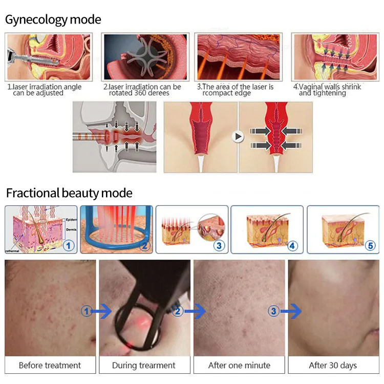 Vaginal tightening fractional CO2 laser / CO2 fractional laser scar removal machine for sale