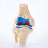 Modèle anatomique du genou à 4 étapes : Comparaison normale et pathologique des os du genou, modèle de visualisation de la progression de l'arthrose