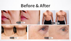 3 handles vertical <strong>Hifu</strong> Wrinkle Removal Facial Y Corporal <strong>Hifu</strong> <strong>High</strong> <strong>Intensity</strong> <strong>Focused</strong> <strong>Ultrasound</strong> Skin Tightening - Product Image 5