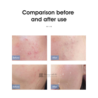 Stylo à ozone plasma professionnel, appareil de beauté pour le visage, nettoyage en profondeur de la peau, élimination des cicatrices d'acné, soin de la peau pour salon de beauté