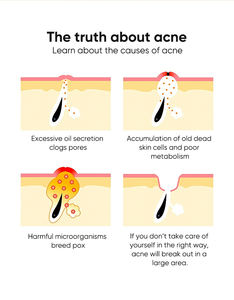 Krim Perawatan jerawat asam salisilat pengecil pori-pori, Gel penghilang bekas luka Anti Noda, perbaikan cepat efektif - Product Image 3