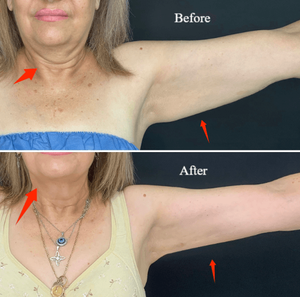 Endoláser de Doble Onda 980nm 1470nm para Dermatología, Eliminación de Venas Vasculares, Cirugía Plástica, Lifting Facial y Rejuvenecimiento de la Piel - Product Image 3