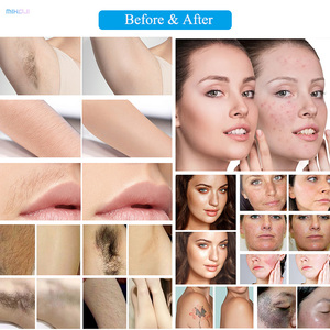 Máquina de depilación vertical <span class=keywords><strong>Alex</strong></span> Andrite y eliminación de tatuajes - Product Image 4