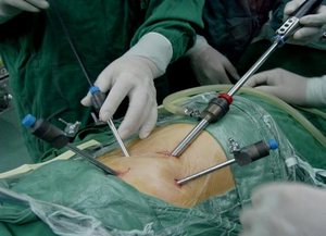 Laparoskop sistem kamera endoskopi laparoskop, 10mm laparoskop otomatis aliran tinggi intifflator CO2 - Product Image 6