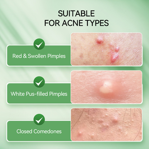 Suero Antiacné LANBENA con 5% de Niacinamida + 2% de Ácido Salicílico para Reparación de la Piel, con 20 Hisopos de Algodón - Product Image 4