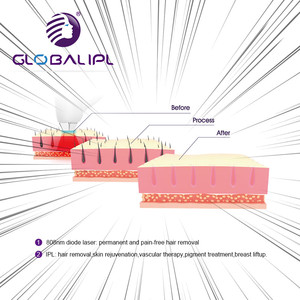 Globalipl เลเซอร์ไดโอดแบบ2 in 1สำหรับ808nm + เครื่องถอนขน <span class=keywords><strong>IPL</strong></span> SHR อุปกรณ์ความงามระดับมืออาชีพสำหรับร้านเสริมสวย - Product Image 4
