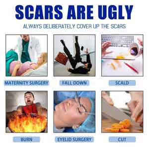 Crema para Eliminar Cicatrices South Moon 15g, Crema para Cicatrices Cóncavas y Convexas, Quemaduras, Quemaduras por Contacto con el Calor, Cicatrices de Cesárea, Reparación de la Piel, Crema Coagulante - Product Image 4