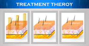 Máquina láser para eliminación de venas vasculares/spider, 980 nm, tratamiento de rosas - Product Image 5