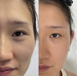 Ollyvia  Remplisseurs pour les tempes, les plis nasogéniens et les <span class=keywords><strong>joues</strong></span> affaissées - Product Image 4