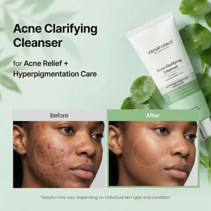 Detergente Purificante Profondo per Acne a Marchio Privato, Controllo del Sebo, Equilibrio dell'Idratazione e Pulizia dei Pori - Product Image 4