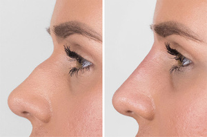 Vente en gros – Acide hyaluronique réticulé BDDE approuvé CE, non chirurgical, pour remodelage nasal et augmentation du <span class=keywords><strong>volume</strong></span> du nez - Product Image 2
