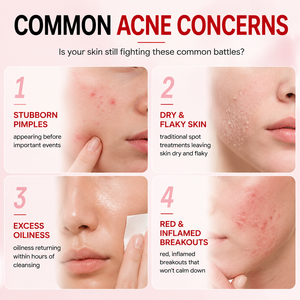 Loción Secante Nocturna 3H para el Cuidado de Granos y Imperfecciones 20ml con 25% de Calamina, Ácido Salicílico y Aceite de Árbol de Té, Solución Vegana para Manchas - Product Image 3