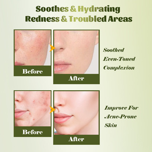 Set de Crema y Suero para Atenuar Marcas de Acné con Ácido Azelaico y Niacinamida: Reduce Manchas Rojas y Oscuras, Unifica el Tono |   Directo de Fábrica - Product Image 2