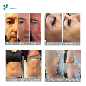 Machine HIFU 4D professionnelle anti-âge 2 en 1 pour le raffermissement de la peau du visage, l'élimination des rides, utilisation en salon - Product Image 3