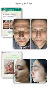 6 in 1 Aquaフェイシャルマシンポータブルハイドラダーマブレーションスキンケアフェイシャルビューティーデバイスプロフェッショナルダーマブレーションフェイシャルマシン - Product Image 5