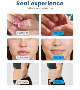 Láser de Diodo Multifunción de 980nm 6 en 1, de Escritorio y Portátil, para Eliminación Vascular, Tratamiento de Hongos en las Uñas y Rejuvenecimiento - Product Image 6