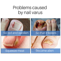 Patchs de réparation des ongles multi-usages Traitement des ongles des orteils Autocollants de correction des ongles antifongique Patch de réparation des ongles de marque privée