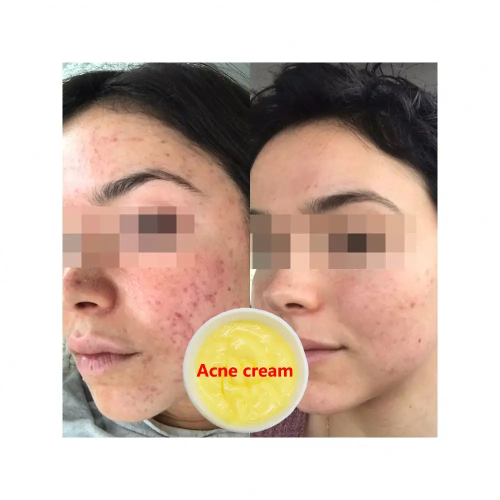 Factory Price Skin Repair Dark Scar Removal Cream Natural Keloid Acne Scar Removal Face Cream