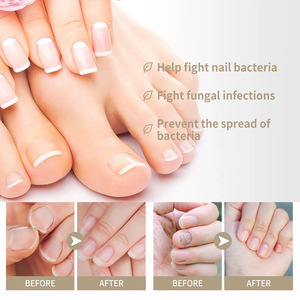 Tratamiento Herbal Antihongos <span class=keywords><strong>para</strong></span> <span class=keywords><strong>Uñas</strong></span> <span class=keywords><strong>de</strong></span> Marca Privada, Suero <span class=keywords><strong>para</strong></span> el Cuidado <span class=keywords><strong>de</strong></span> <span class=keywords><strong>los</strong></span> Pies, Onicomicosis, Paroniquia, Loción <span class=keywords><strong>para</strong></span> <span class=keywords><strong>Hongos</strong></span> en <span class=keywords><strong>las</strong></span> <span class=keywords><strong>Uñas</strong></span> - Product Image 5