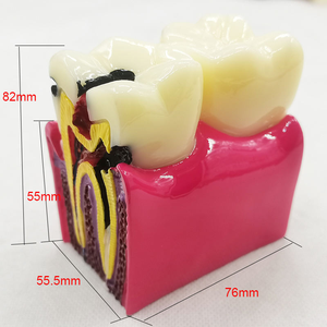 Modello Comparativo di Denti con 6 Volte Più Danni, Modello di Denti in Resina Dentale Smontabile - Product Image 4