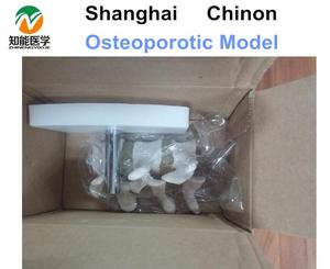 Humanos osteoporóticas <span class=keywords><strong>esqueleto</strong></span> óseo anatómico modelo - Product Image 3