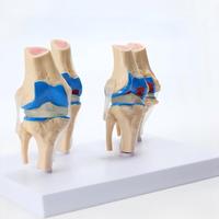Modèle anatomique du genou à 4 étapes : Comparaison normale et pathologique des os du genou, modèle de visualisation de la progression de l'arthrose