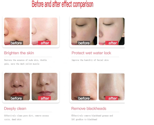 Solución aqua Peeling para limpieza Facial, removedor de espinillas, 3 botellas de suero Facial para el cuidado de la piel - Product Image 3