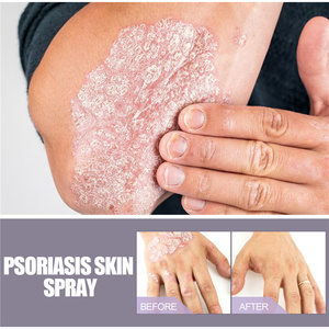 Eelhoe Spray de 30 ml para <span class=keywords><strong>Eczema</strong></span> y Psoriasis, Inflamación de la Piel, Enrojecimiento, Picazón, Tratamiento Líquido para Psoriasis, <span class=keywords><strong>Eczema</strong></span> y Dermatitis - Product Image 6