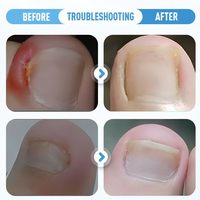 Kit de correcteur d'ongles professionnel de vente chaude outils de Correction de Paronychia soin des pieds incarnés patch correcteur d'ongle d'orteil