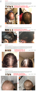 Solución para el cuidado del cabello, espray para el crecimiento del cabello, 100% Natural, a base de hierbas, reparador OEM, solución anticaída de pelo - Product Image 6