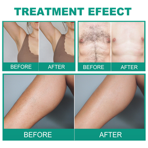 Máquina elétrica da eletrólise do depilador do dispositivo eletrolítico permanente da remoção do cabelo com o <span class=keywords><strong>Needle</strong></span>-10pcs para a remoção branca do cabelo - Product Image 6