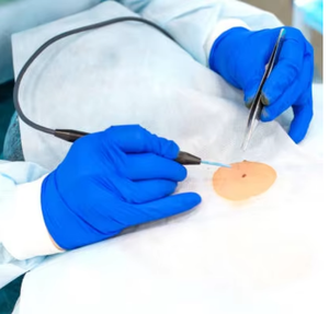 Máquina de electrocauterización portátil para dermatología quirúrgica Uso veterinario y dental con alta frecuencia y precisión - Product Image 4