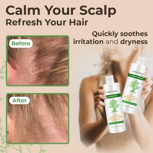 2025 Nuevo diseño <span class=keywords><strong>Eczema</strong></span> Psoriasis Champú y acondicionador Set para hombres y mujeres-Champú anticaspa para cuero cabelludo seco y cabello - Product Image 5