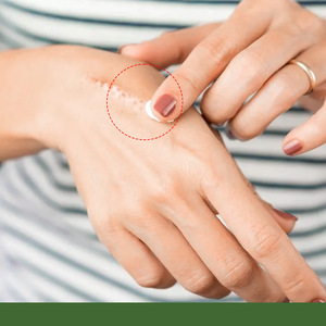Crème de traitement des cicatrices à la camomille avancée, cliniquement testée pour les marques de brûlures, les cicatrices d'accidents, favorise la régénération - Product Image 2
