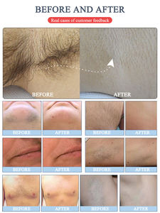 Gran potencia CE aprobado láser 808nm 755nm 1064nm máquina de depilación láser de diodo de alta potencia - Product Image 6