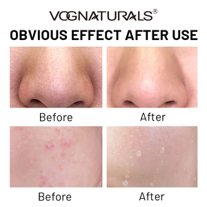 Peróxido de Benzoilo OEM al <span class=keywords><strong>10</strong></span>%, Espuma Limpiadora para el Acné, Máxima Potencia, Limpiador Facial Antimicrobiano de Limpieza Profunda para Eliminar Puntos Negros - Product Image 4