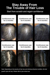 جهاز LLLT لنمو الشعر لمنع تساقط الشعر والتدليك الصحي لفروة الرأس بالليزر PDT بالأشعة تحت الحمراء ضوء أزرق أحمر عالي الطاقة جهاز نمو الشعر LLLT - Product Image 5