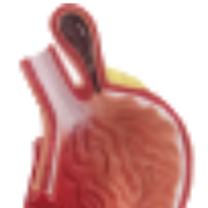 Modèle de Pathologie Gastrique D021F/D021G pour l'enseignement et l'apprentissage de l'Anatomie en Sciences Médicales pour la Formation des Infirmières - Product Image 5