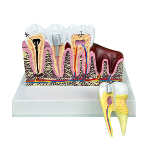 Mô hình giảng dạy y học nha khoa tính toán nha khoa, sâu răng, sâu răng, hoại tử, mở rộng 4 lần mô hình bệnh lý toàn diện của răng - Product Image 6